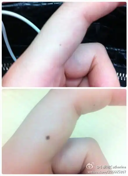 手上突然长了一个痣,在食指上,一年内长大了很多