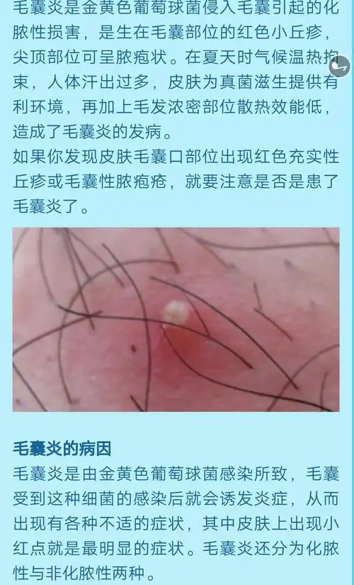 汗出过多,真菌感染,皮肤易得毛囊炎