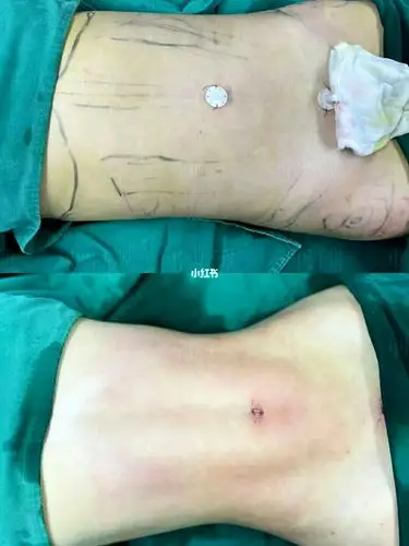 威塑腰腹环吸_腰腹_环吸_减肥_减肥日常_减肥_减肥医药