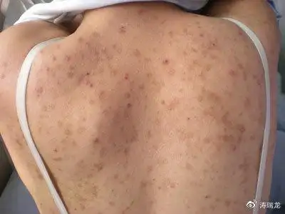 背部反复长痘应该咋办好