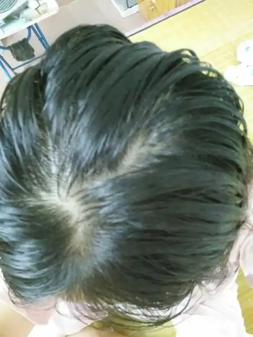 女30岁,最近总是头发油,头皮痒,掉头发厉害,头发明显少了好多,求助