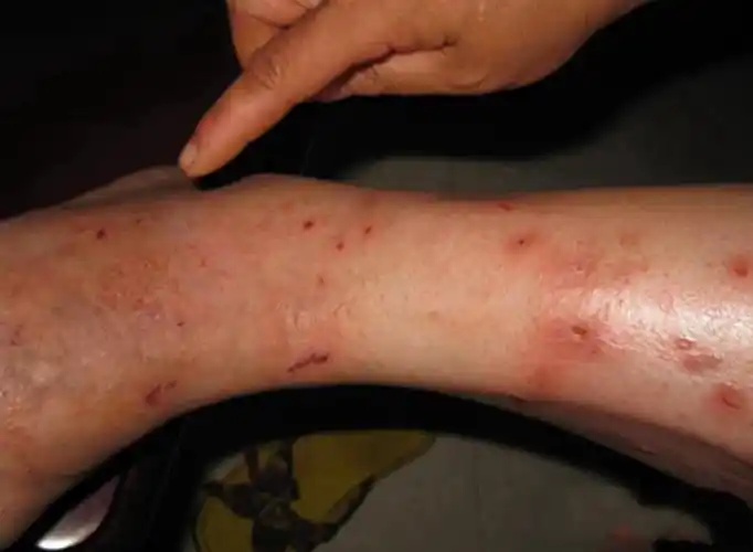 大人湿疹症状图片_有来医生