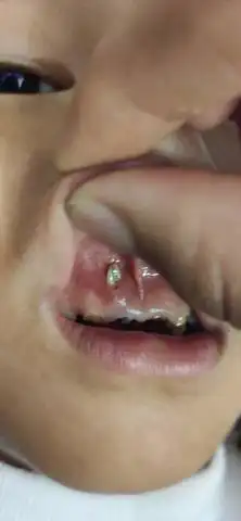 宝宝牙龈上长牙齿怎么办