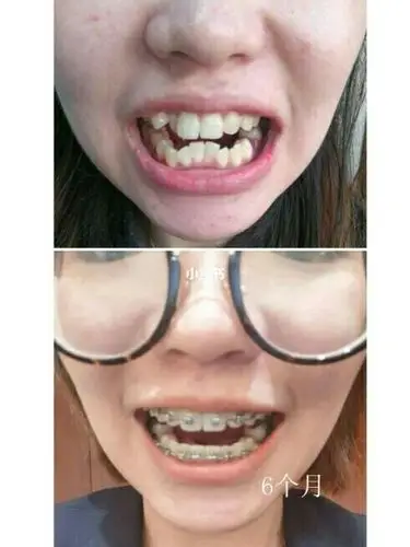 3个月龅牙虎牙全部归队 9999整牙之前我的牙齿问题是:龅牙,下牙不