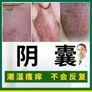 阴囊瘙痒去潮湿肛门私处瘙痒毛囊炎睾丸痒膏冰霜男女私处止痒神器