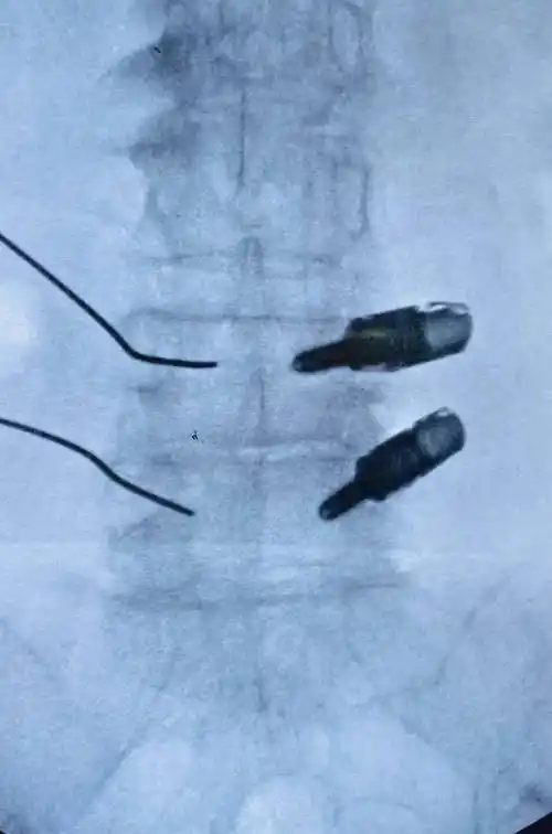 医院成功开展ube技术下3d打印钛合金椎间融合器植入经皮置钉内固定