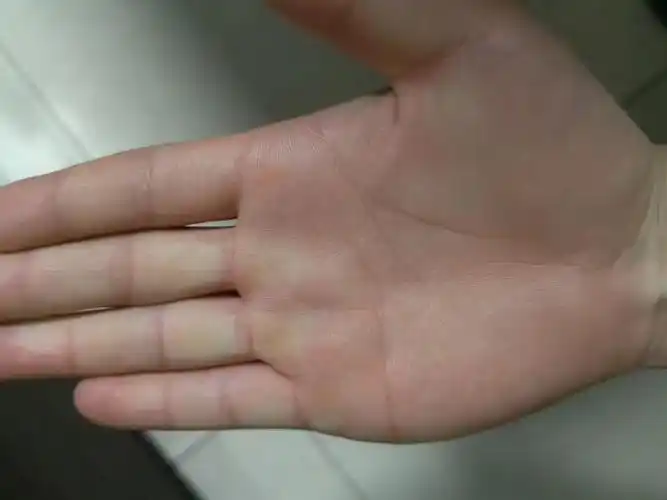 手相,这么大的岛纹怎么回事