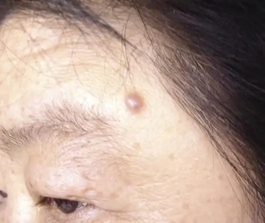 皮肤性病科图谱皮肤肿瘤毛母质瘤