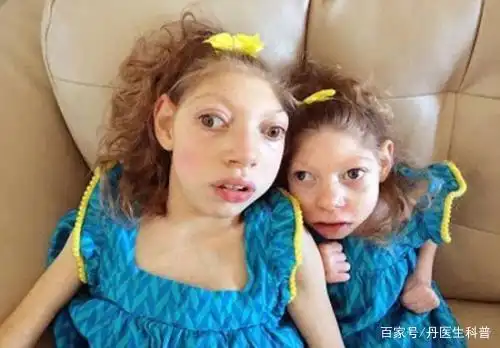 马方综合征,先天性结缔组织疾病,具有遗传性,目前治疗手段有限