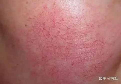 敏感肌肤,皮肤容易红该怎么去护理? - 知乎