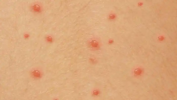 病毒疹和病毒性皮肤病