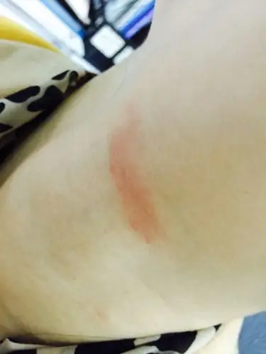 红的地方还有点干,好像有一块皮癣一样,已经持续快一个月了,整个脖子