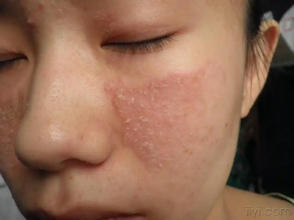 脂溢性皮炎诊断病例一例