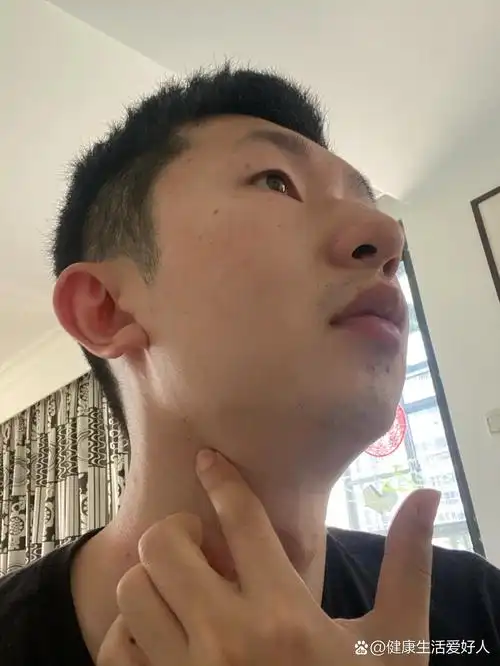 颈部淋巴结肿大