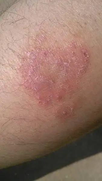 不知什么原因腿上破了一块皮,没去管它,然后慢慢发痒,一月了,就变成