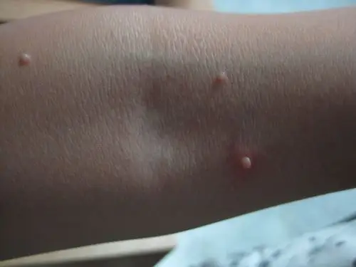 小孩子胳膊上起了好多小肉瘤,怎么办