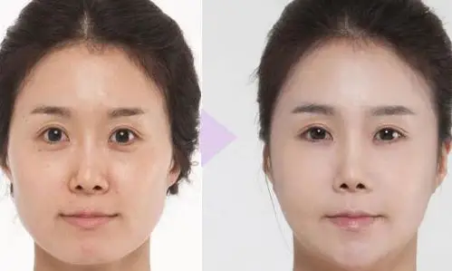 玻尿酸填充泪沟可没有想象中简单