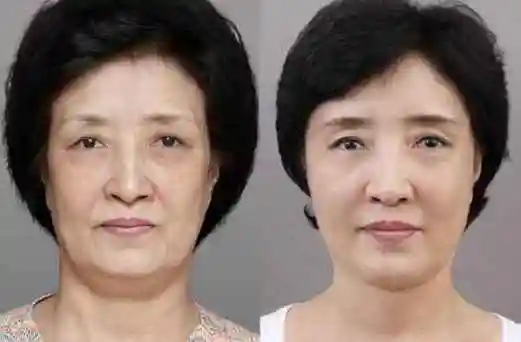 紧致皮肤除皱的方法