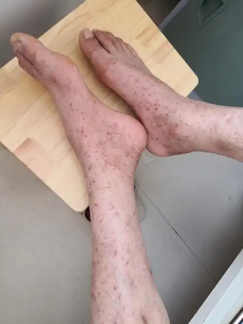 男子高烧不退全身红疹的原因竟是被这种虫子咬了夏日户外活动多这些