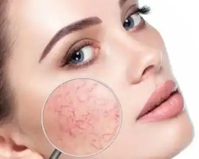 去红血丝注意事项_肤康皮肤专科医院