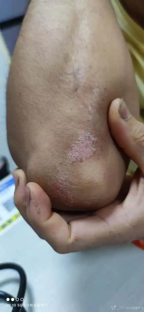 看图诊断第84期肘部踝关节片状红斑冬轻夏重考虑