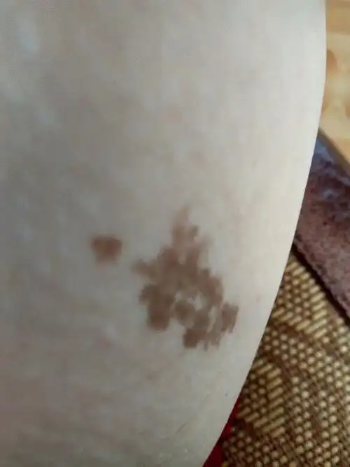 我大腿内侧这个是什么呀,以前就有,像痣但又是一大块,不知道到底是