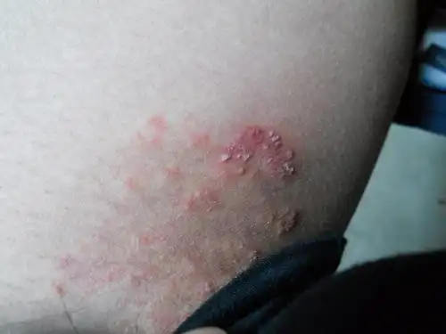 股癣_治疗_症状_鉴别_股癣专家免费咨询_快速问医生