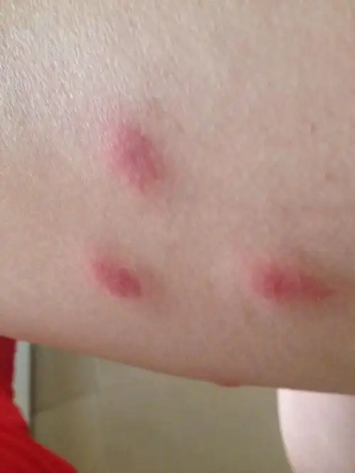 大腿上出疙瘩 又大又红又痒 怎么回事啊