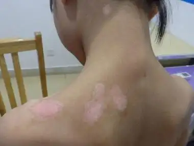 我的背上有一个大白斑.