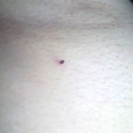 问:今天发现腋下长一个黑小疙瘩,怕怕～宝妈们知道这是什么吗?