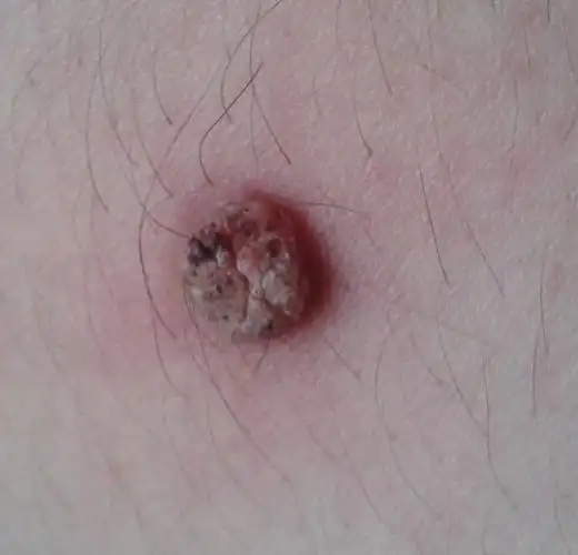 腿上长了个刺瘊子