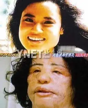 明星整容可怕后遗症 文颂娴婚前求靓变破相(组图)