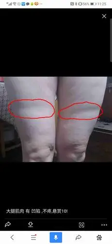 产后发现两边大腿中间位置一圈都凹陷下去了,怎么回事?