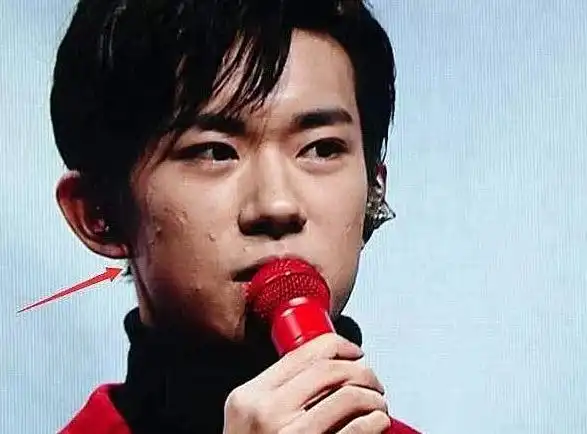 tfboys素颜照:王源一脸痘,王俊凯青春痘,易烊千玺有痘坑