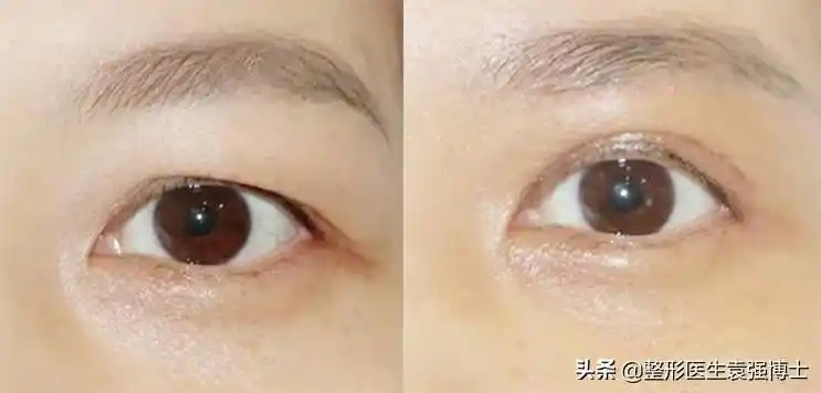 眼皮太厚怎么办上眼皮松弛凹陷怎么恢复