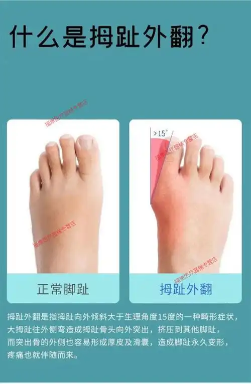 大脚趾拇指外翻器日夜用成人可穿鞋男女士大脚骨拇外翻分趾器两指器2