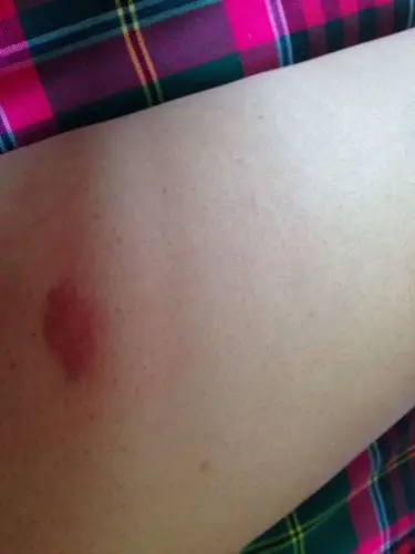 大腿根内侧 摸起来像被蚊虫叮咬的感觉 一直红肿 有痒痒的感觉