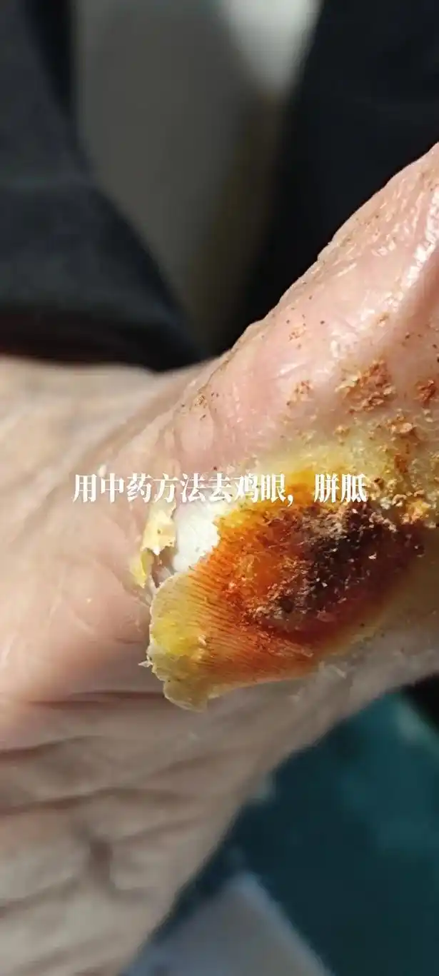 用中药方法去鸡眼,胼胝.中医外科 - 抖音
