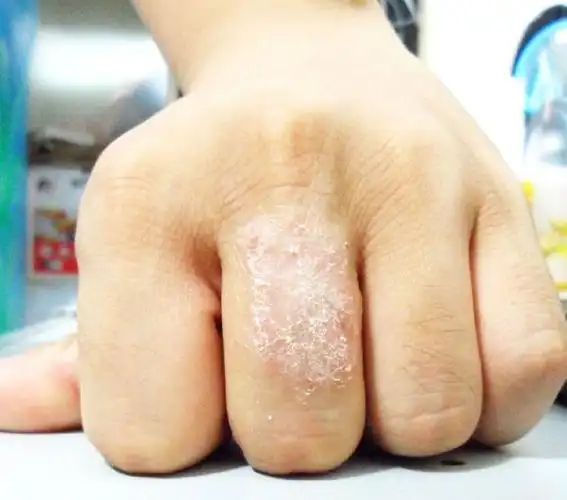 湿疹是怎么引起的_得了湿疹怎么治疗_湿疹吃什么药好_5号网