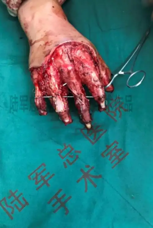 全手脱套伤修复