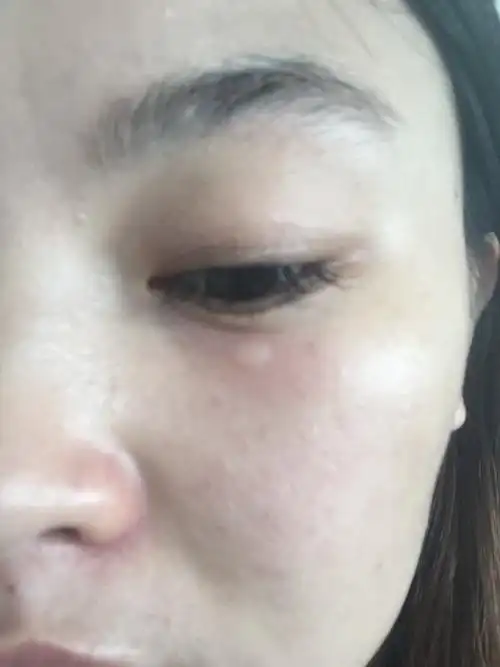 眼睛下面突然起了一个扁包,稍微有一点点养,不知道是什么东西,求解