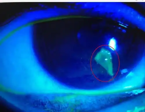 春季儿童眼外伤频发 6岁男孩角膜被铅笔戳伤