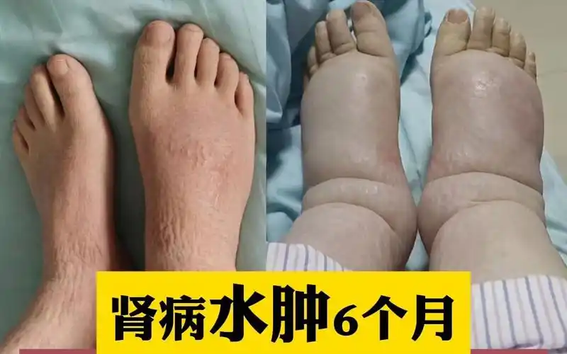 狼疮性肾病患者活跃期,水肿厉害,治疗10天后,消肿23斤!