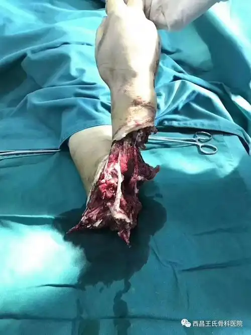 【案例】 钢绳勒断前臂 显微外科显威_断肢