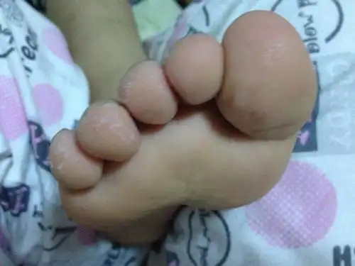 问:我儿子5周多脚皮肤脱皮,我有香港脚是不是传染给他了