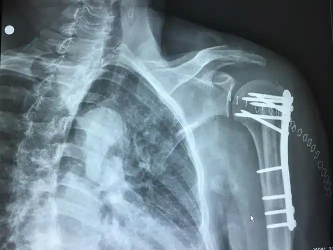 位片投照要点*广东省中医院大学城运动创伤关节镜专科 写美篇肩部创伤