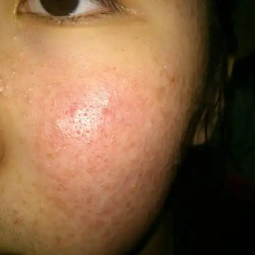 一个美容师说我的皮脂膜被破坏了,真的吗,脸很红