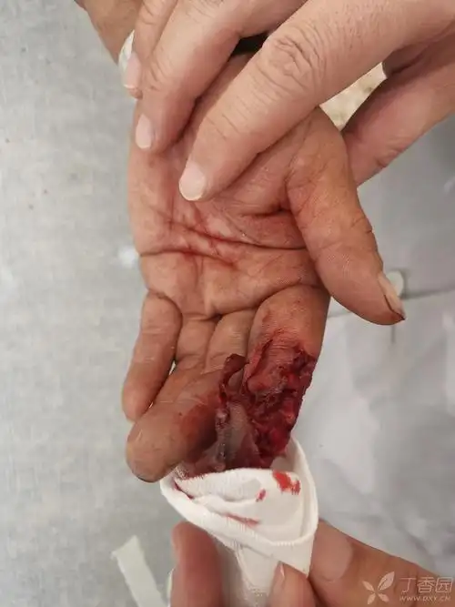 女性,机器碾压伤,导致左手示中节以远指桡掌侧皮肤软组织挫伤,局麻