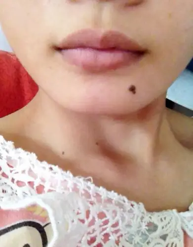 脸上的痣都可以点么?