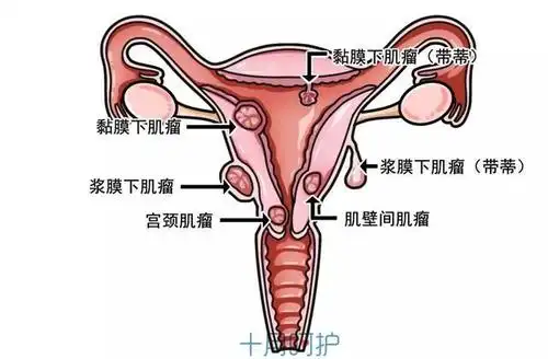 女明星不懂妇科常识差点去堕胎,女人子宫长了它照样有权利生孩子